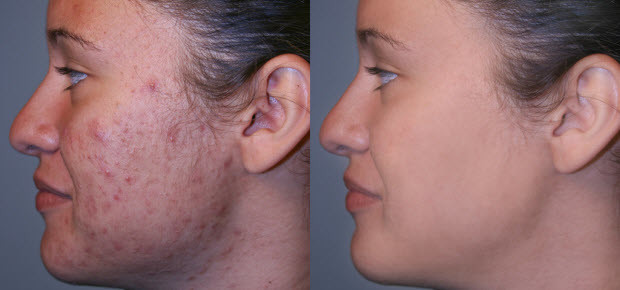 Skin maintenance microneedle nurse system Fractional radiofrequency micro needling
