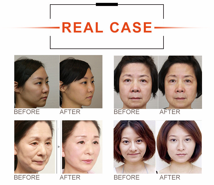 Anti Aging HIFU Facial Lifting Portable Ultrasonic HIFU Beauty Machine