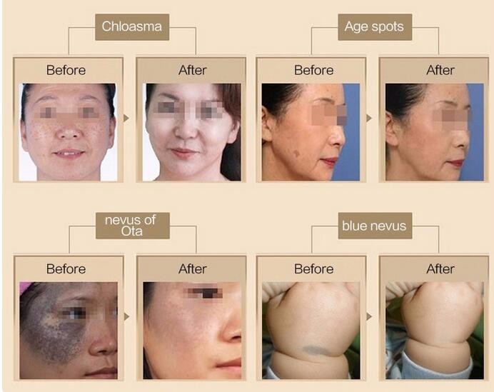 Korea /pigmenation removal Picosure all colour tattoo removal Picosecond aesthetic
