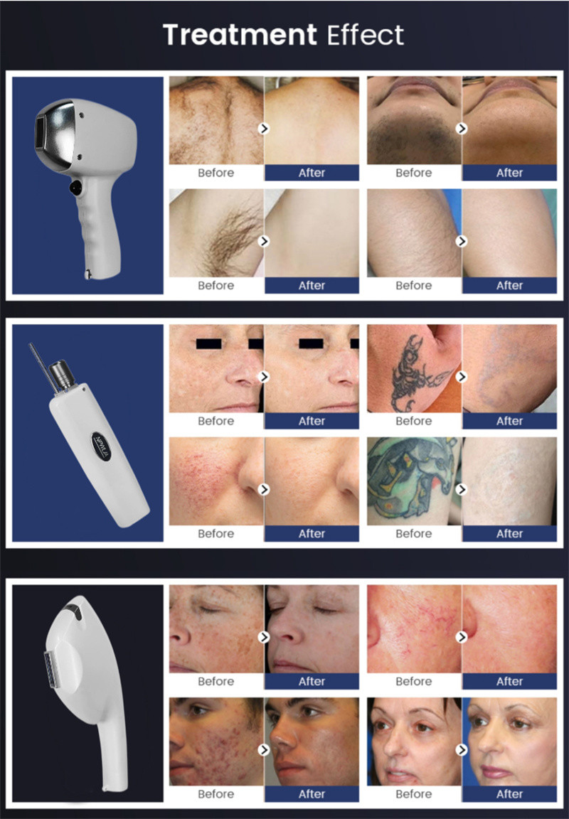 Multifunctional 3 In 1 808nm Diode Laser Hair Removal Tattoo Removal