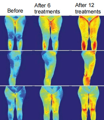All In One 10D Slimming Roller Laser Equipment With Biolight Technology For Clinics And Spas