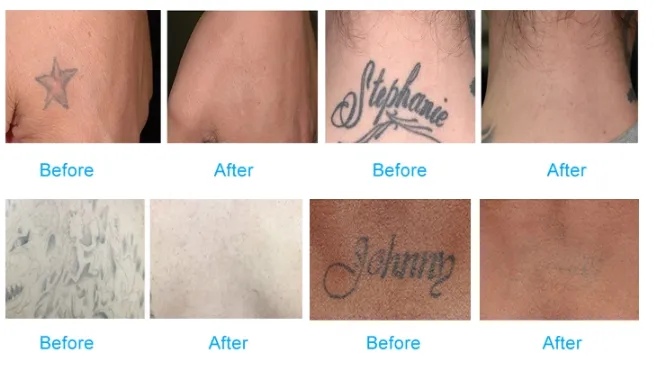 Tattoo Removal Q Switch Nd Yag Pigment Removal Carbon Peeling Laser Machine Skin Rejuvenation For Beauty Salon Use