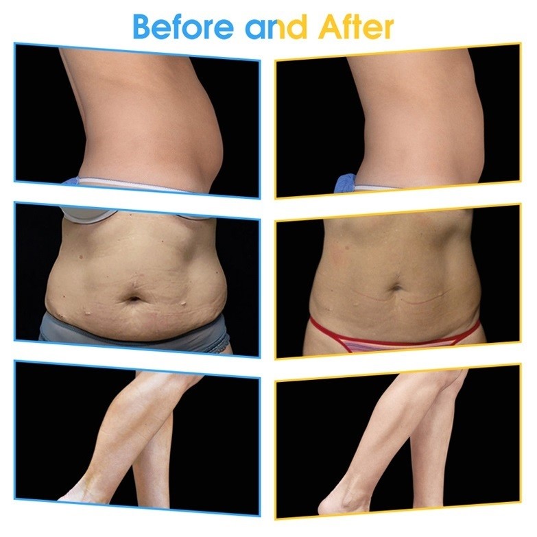 EMS Weight Loss Machine EMSCULPT Hi-Emt Emslim Body Slimming Muscle Stimulation