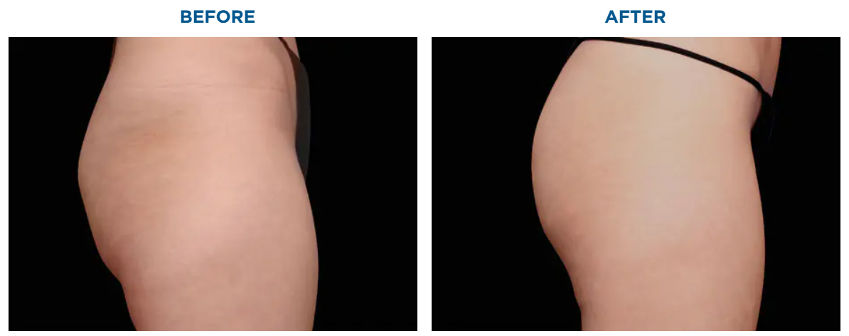 Fat Cell Cryoslimming Machine Cryotherapy 360 Cryoslim Fat Cell Freezing Machine