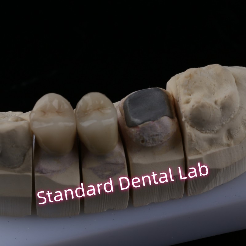 Metal Cast Post Core Crown Cocr Accurate Retentive Full Zirconia Bruxier