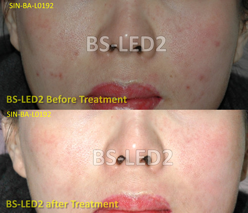 Three Color Infrared Led Light Therapy Skin Care Device