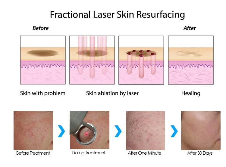 Glass Tube Co2 Fractional Laser Machine 635nm For Skin Birthmark Acne Removal