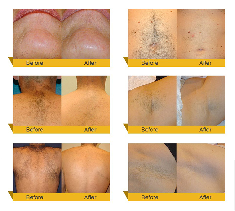 Permanent Ladies Hair Removal Machine 808nm Wavelength For Long Time Working