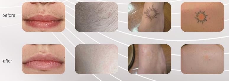 Nd Yag 808nm Diode Laser Hair Removal Machine 1 - 10Hz Frequency 10 - 300ms Pulse Width