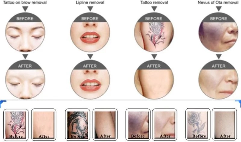 532nm 755nm 1064nm Vertical Q Switch Picosecond Laser for Acne Removal