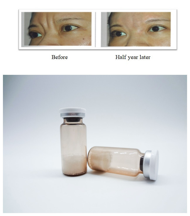 350mg 150mg PLLA Dermal Filler OEM Customization Injectable Plla For Long Lasting Results