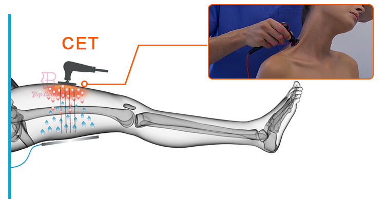 Resistive Rf Tecar Therapy Machine Sports Rehabilitation