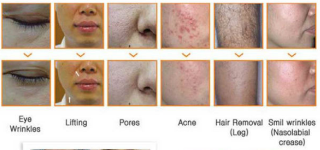 China professional best home portable ellipse ipl intense pulse shr facial body hair removal machine with cheap cost