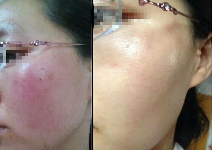 Red Blood Vascular Laser Spider Vein Removal Machine 980nm Skin Rejuvenation