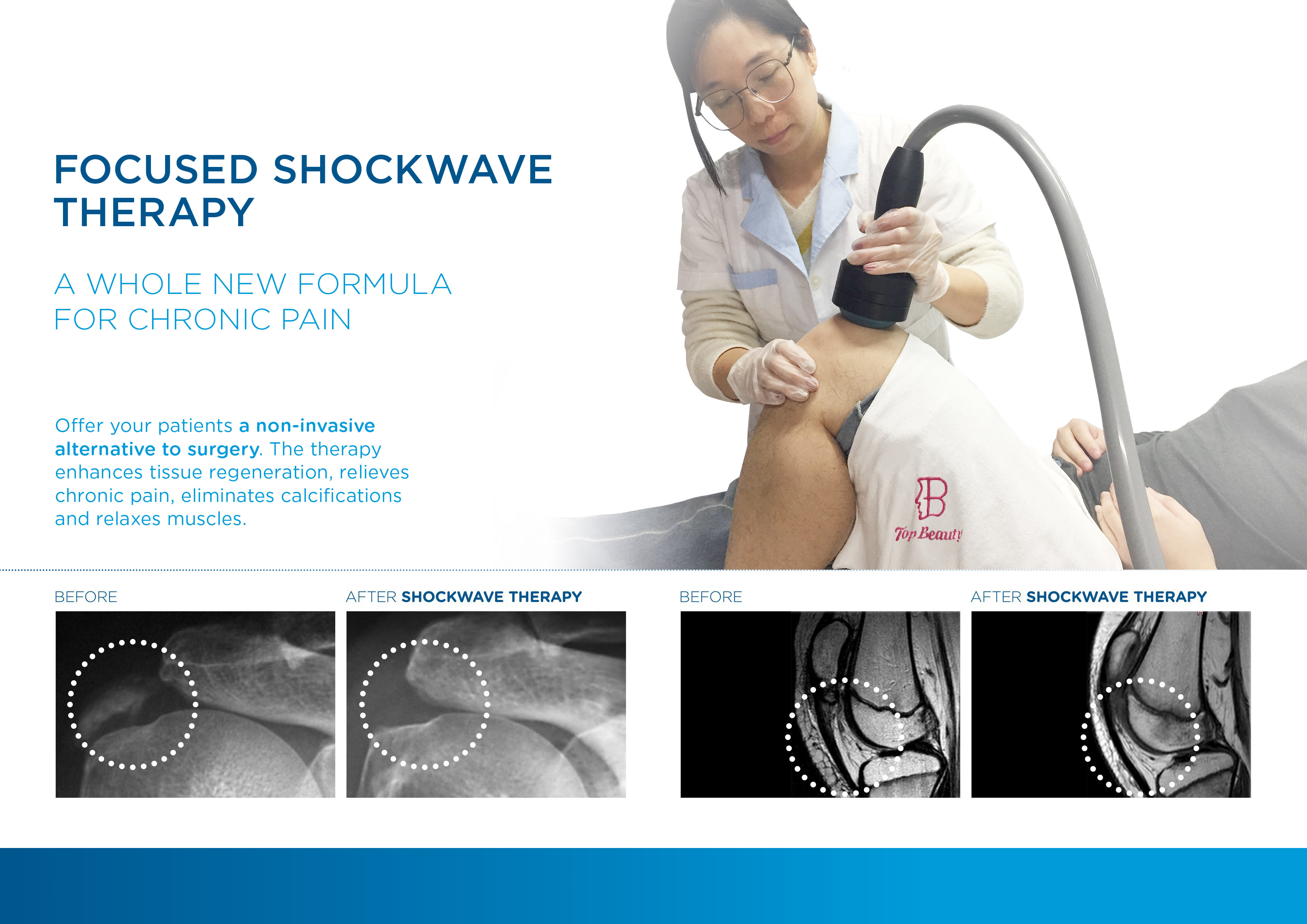 Shockwave Therapy Device ED Shockwave Erectile Dysfunction Focused Shockwave Machine