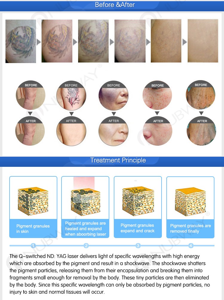 2017 imported nd yag ktp laser for spa beauty tattoo removal