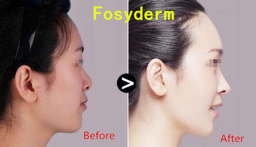 Hyaluronic Acid Injection Nose Dermal Filler , Hyaluronic Acid Gel Fillers