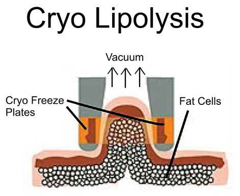 Cryolipolysis fat freeze slimming machine Infrared slimming tunnel