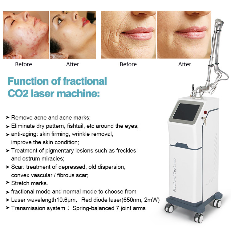 Advanced Fractional Laser Machine for Acne Scars Age Spots and Vaginal Rejuvenation