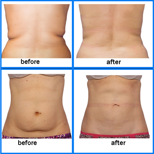 Safe and no invasive natural fat removal machine, crylipolysis machine fat freeze