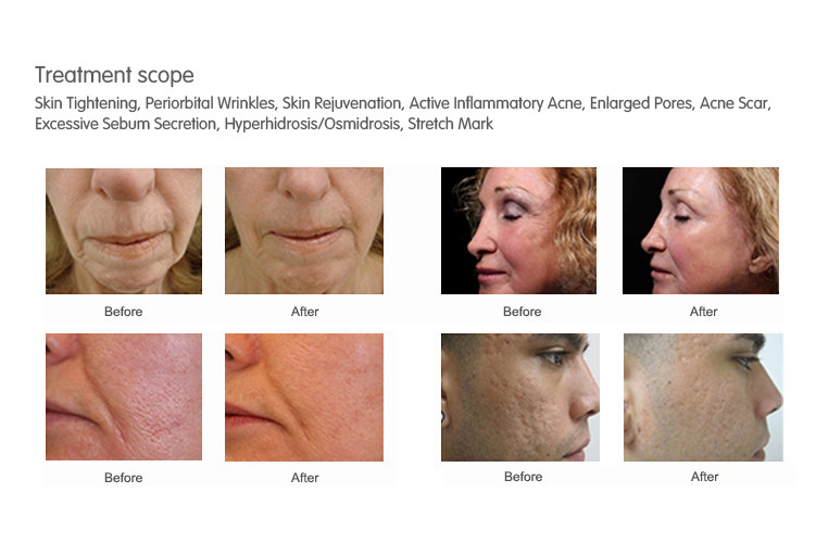 2019 online order free shipping rf fractional micro needle for lipolisis/wrinkles/acne removal