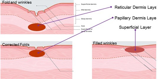 Skin maintenance microneedle nurse system Fractional radiofrequency micro needling