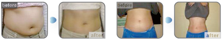 Most popular multifunctional 5 handles 1800W fat freeze cryolipolyses lipo slim machine