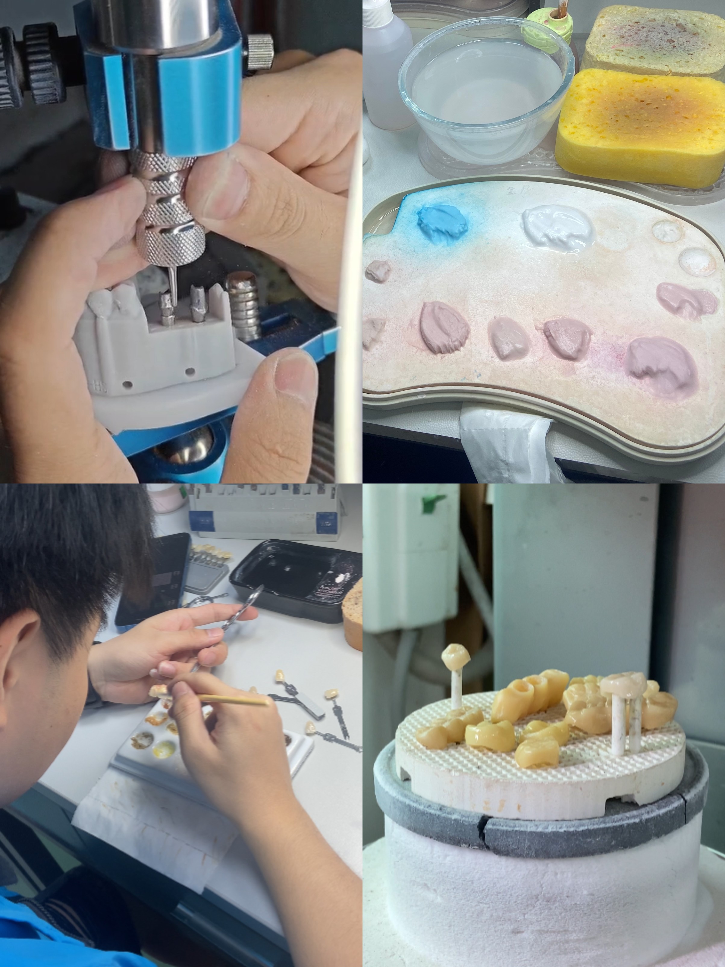 Replace Missing Teeth Dental Implant crown With Screw Titanium Base And Zirconia Crown