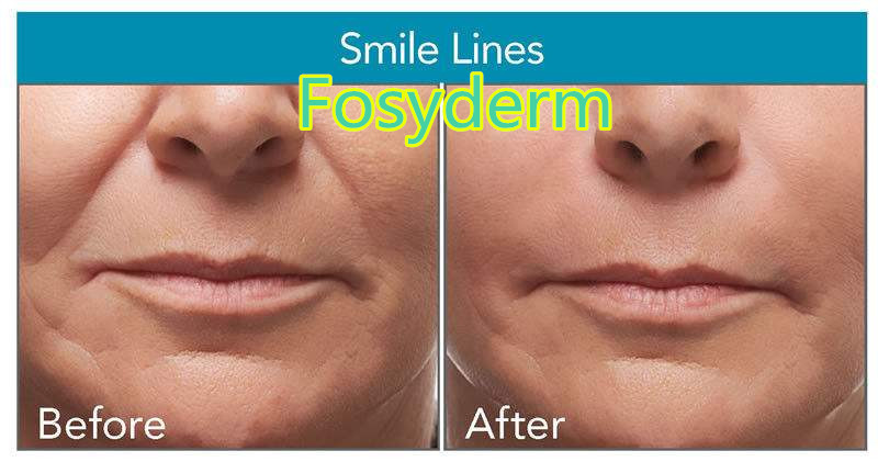 Skin Care Hyaluronic Acid Injectable Dermal Filler for Anti Wrinkle 2ml CE ISO