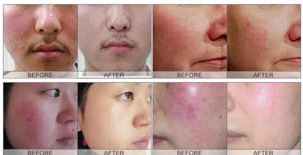 Spider Vein Removal Vascular Removal 980Nm Diode Laser Machine For Spa Salon Use Equipment