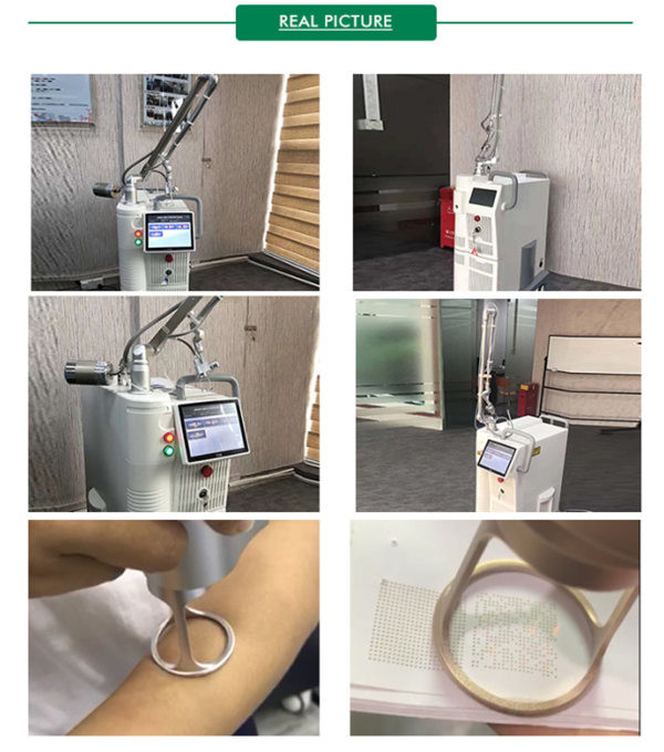 Pigment Removal CO2 Fractional Laser Machine 10600nm Skin Rejuvenation