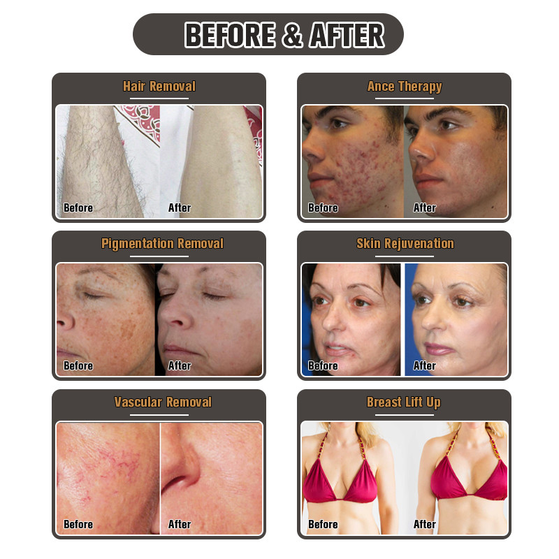 IPL OPT SHR Laser Hair Removal Machine Elight RF Skin Rejuvenation 2500W