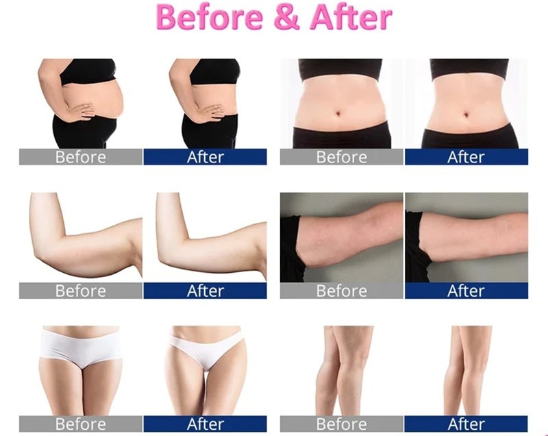 650nm Lipo Laser Pads Laser Liposuction Machine For Reduce Cellulite Fat Removal