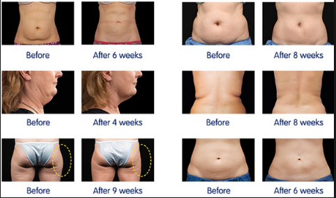 Cryolipolysis Fat Freezing Cellulite Treatment Machine With One Handle For Fat Removal