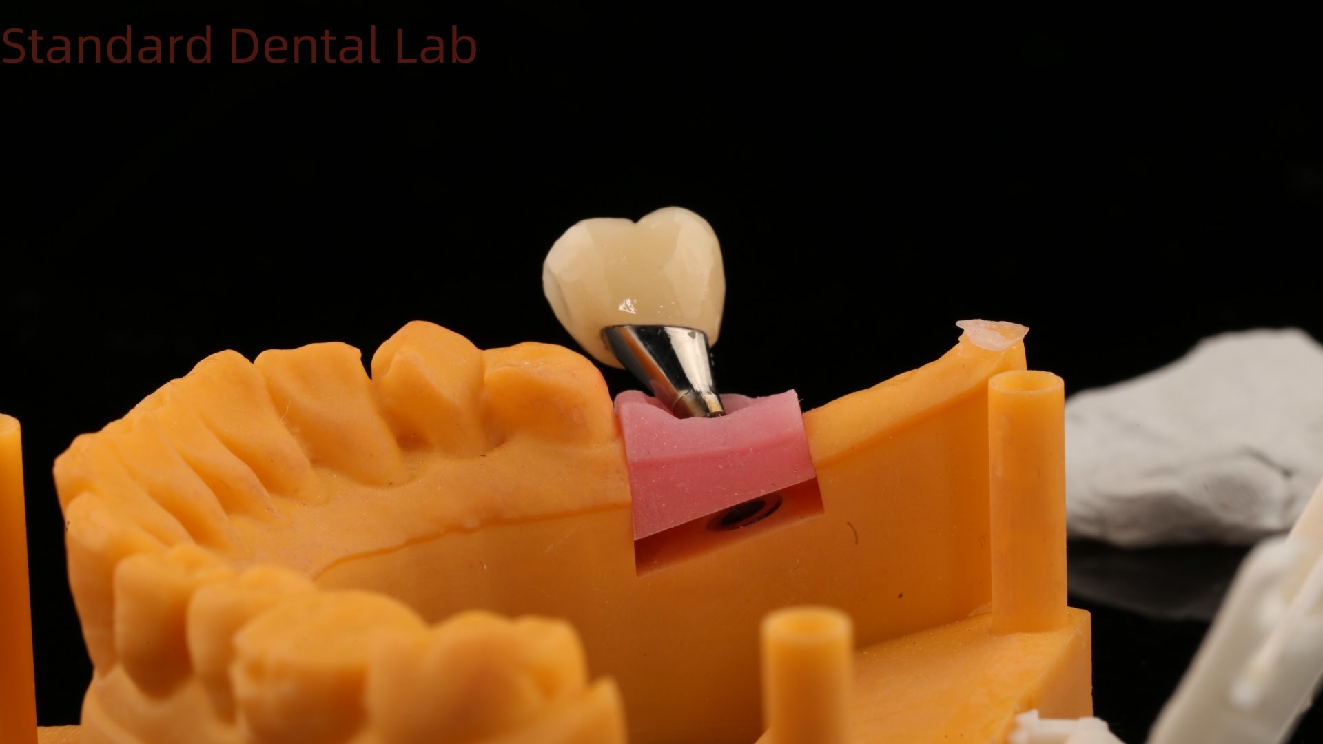Dental Implant Screw Retained Crown PFZ Porcelain Layered Zirconia With 3D Print Model