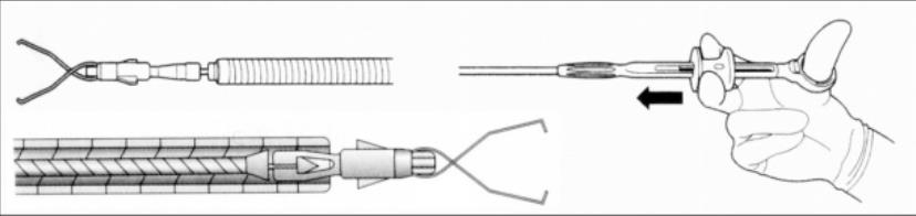 Disposable Rotatable Endoscopic Hemoclip With Straightening Wire