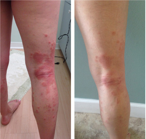 Portable Eczema Treatment UVB Narrowband Phototherapy Device For Home