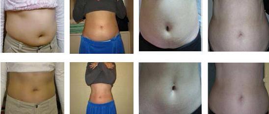 Cryolipolysis Machine-treatment2.jpg