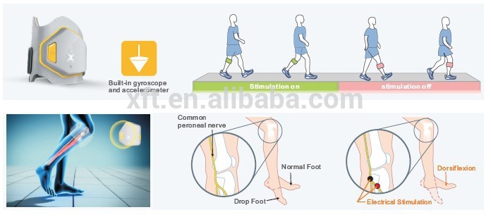 Foot Drop Stimulator XFT G3 Functional Electrical Stimulation Foot Drop System for Drop Foot