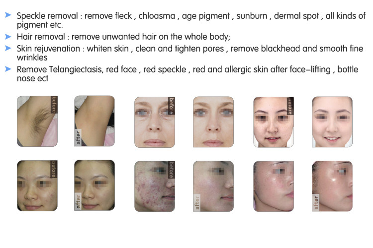 2017 top sale e-light ipl shr hair removal machine