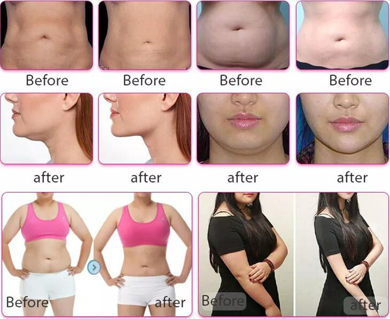 Weight Loss Cryolipolysis Slimming Machine Fat Freezing Liposuction 80kpa