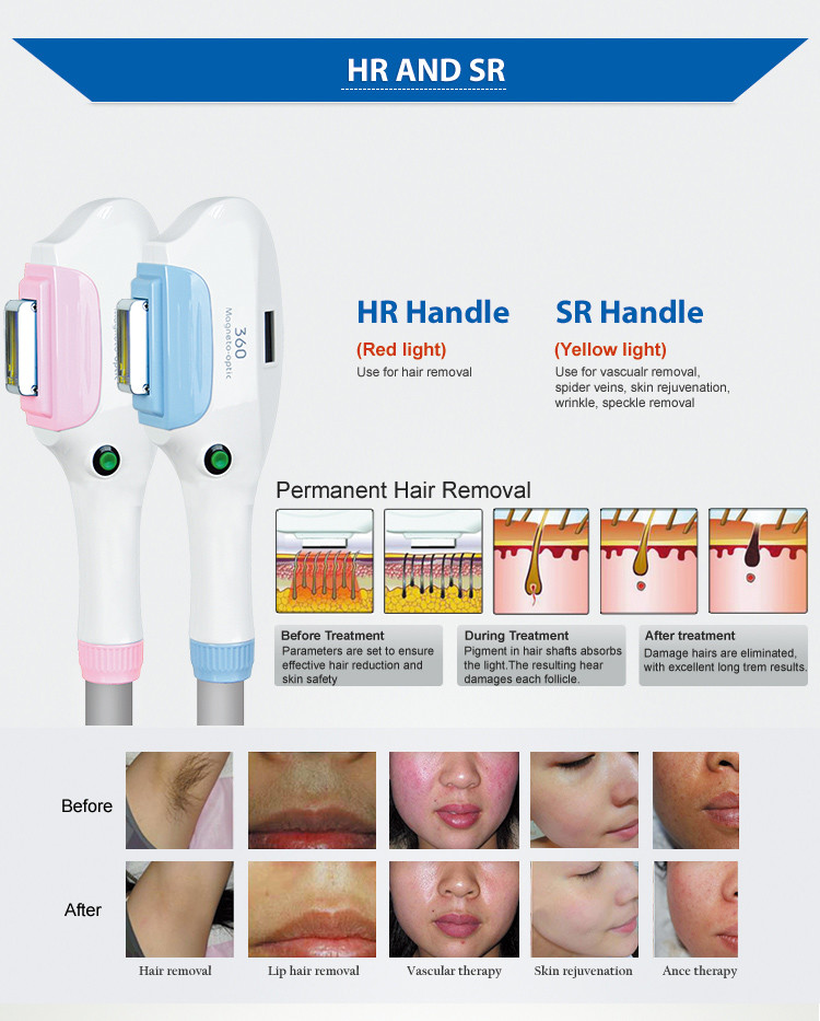 Elos Semiconductor SSR Shr Ipl OPT Laser Hair Removal Machine Ice Cooling 2 In1