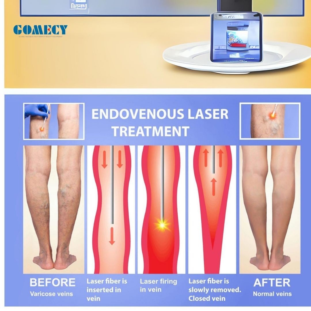 EVLT Varicose Vein Removal Machine Radial Fiber Laser EVLT Endovenous Ablation Treatment Machine