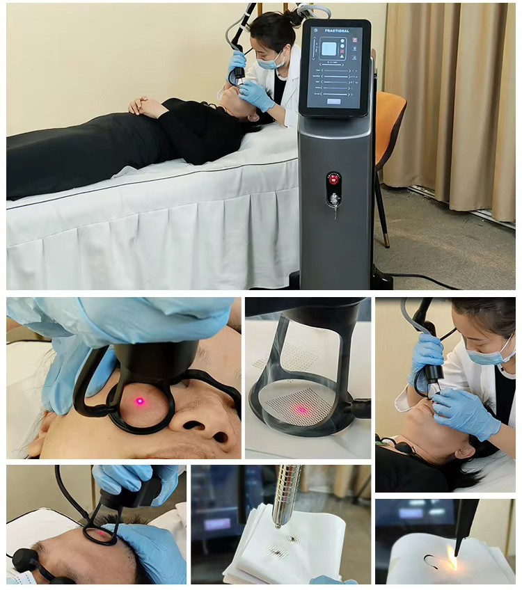 CO2 Fractional Laser Scar Pigment Removal Vaginal Tightenin Device