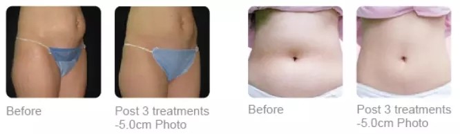 Most Advanced Non-Invasive HIFU Cellulite Ultrasonic Slimming Machine