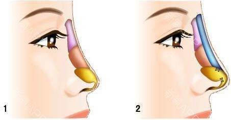 Skin Care Hyaluronic Acid Injectable Dermal Filler for Anti Wrinkle 2ml CE ISO