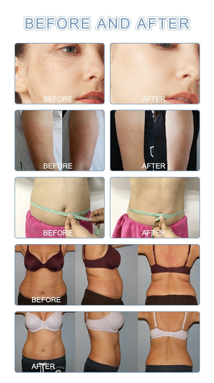 LF-247A multifunction cryo lipolaser cryotherapy slimming weight loss shock wave therapy beauty machine