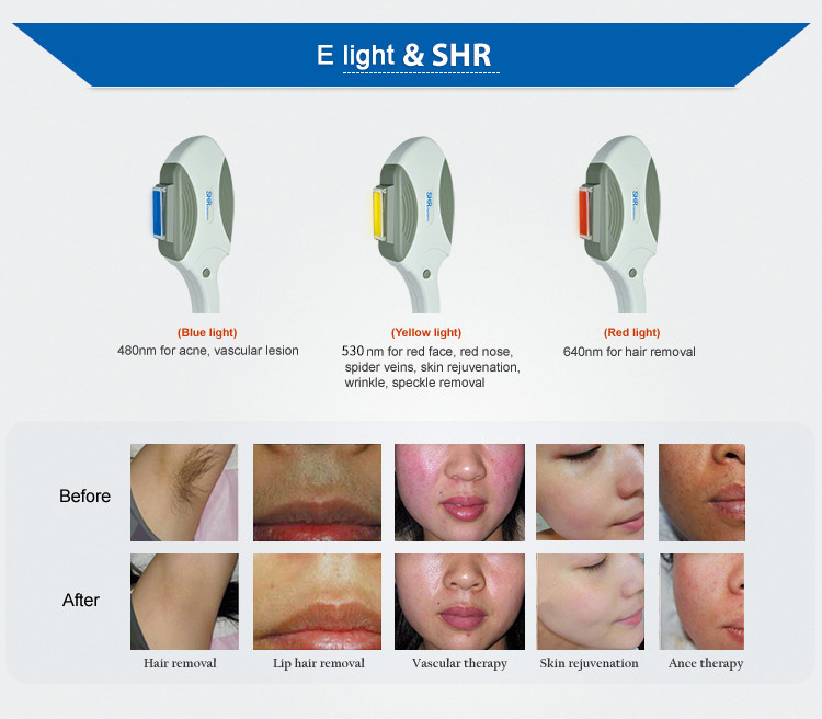 Ipl Photon Painless Armpit OPT Laser Hair Removal Machine Skin Rejuvenation