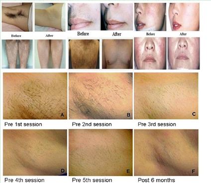 Permanent diode laser hair removal machine for Spa or Salon use