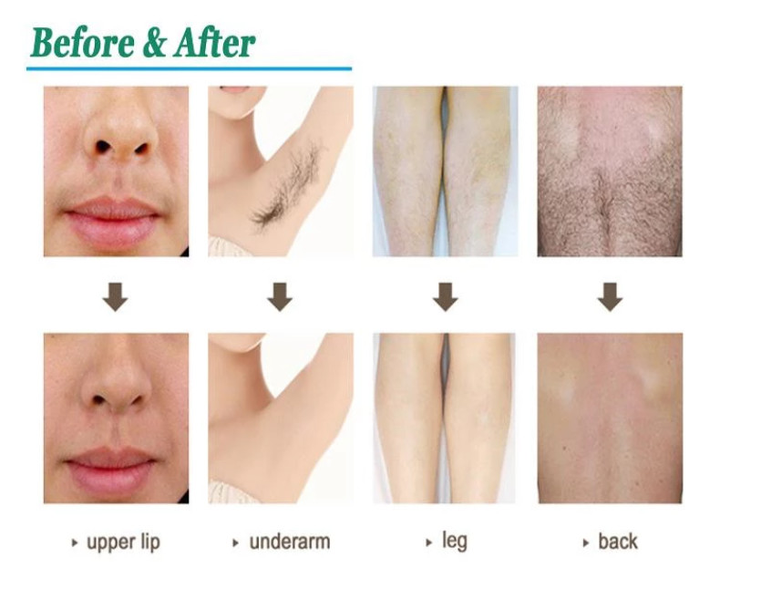 Body Diode Laser Hair Removal Machine Beauty 808 Ice Skin Rejuvenation Instrument
